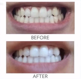 whitening_toothpaste_before and after